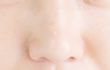 鼻のプチ整形